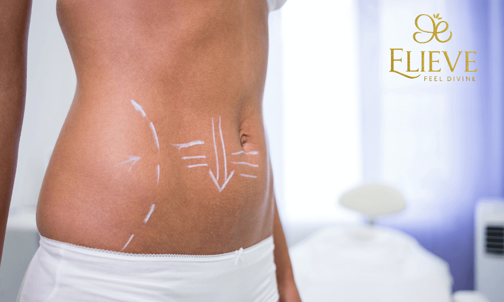Liposuction : The Fat Removal Treatment in Ahmedabad