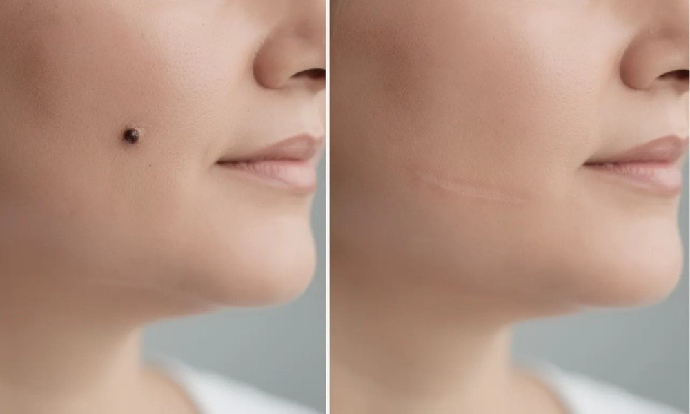 Laser Mole Removal in Ahmedabad 