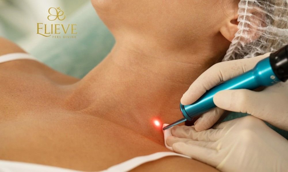 Mole Removal Treatment in Ahmedabad