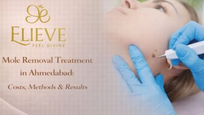 Mole Removal Treatment in Ahmedabad
