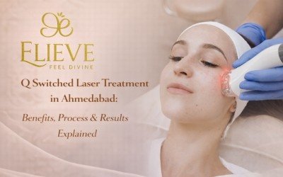 Q Switched Laser Treatment in Ahmedabad