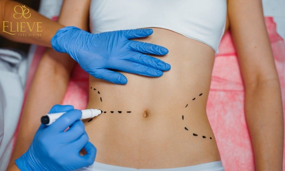 Liposuction Treatment in Ahmedabad