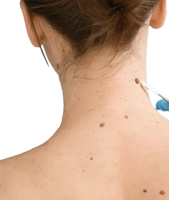 mole-scars-image.webp