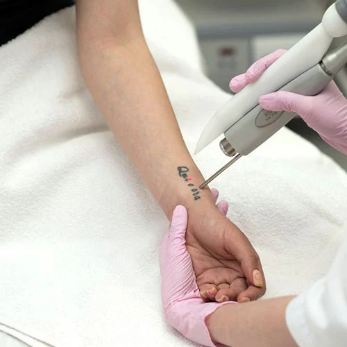 Tattoo Removal 